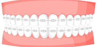 Desmineralización durante el tratamiento ortodóntico hygiene-precision