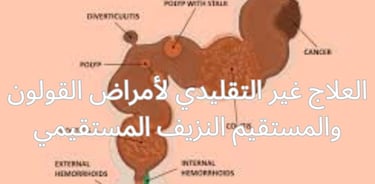 نزيف عبر المستقيم نزيف المستقيم