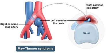 vascular ultrasound may thurner syndrome iliac vein common artery compression deep vein thrombosis swelling leg pain pelvic