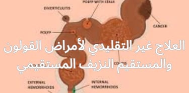 نزيف عبر المستقيم نزيف المستقيم