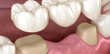 dental bridges