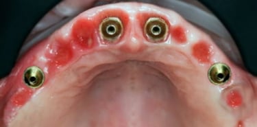 Dental implants placed for the All on 4 procedure