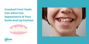 Crooked front teeth can affect the appearance of your smile and lip position