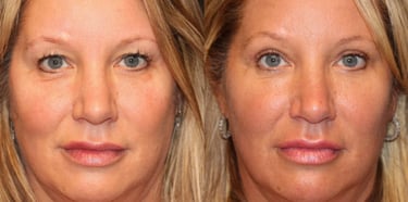 eyelid surgery before after Dr Altan Tekin Antalya