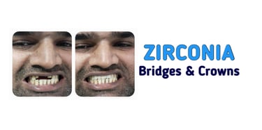 Zirconia Bridges and Crowns in Greater Noida