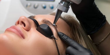 Remoção de tatuagem a laser