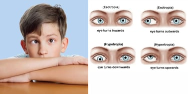 Strabismus, commonly called as squint or crossed eyes, is a condition where the eyes are not properly aligned.