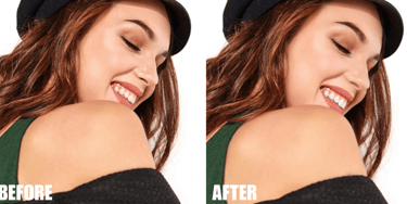 teeth-whitening