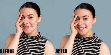 pimple-or-acne-removal