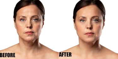 wrinkle-removal