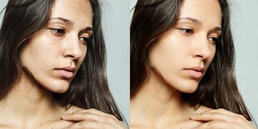 skin-refinement