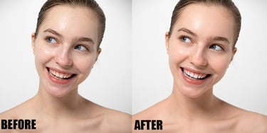 teeth-whitening