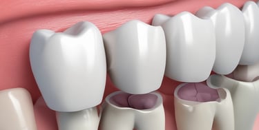 Dental Crowns & Bridges Greater Noida
