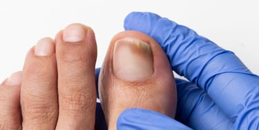 Tratamento de Micose nas Unhas em Joinville | Essence Podologia e Bem Estar