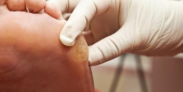 Tratamento de Calos e Fissuras nos pés em Joinville | Essence Podologia e Bem Estar