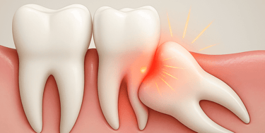 wisdom tooth extraction at Peoples Dental Clinic Greater Noida