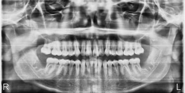 Wisdom Tooth Extracted