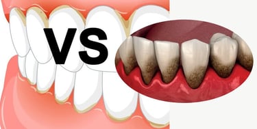 Différences Gingivite et Parodontite hygiene-precision.com