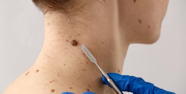 medicina estetica asportazione nei rovereto trento