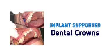 Implant Supported Dental Crowns