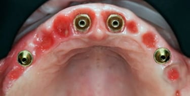 Dental implants placed for the All on 4 procedure