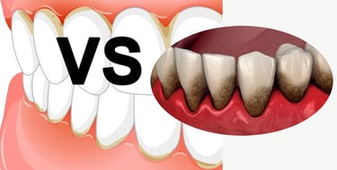 Différences Gingivite et Parodontite hygiene-precision.com