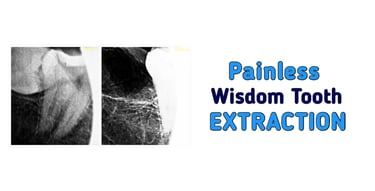 Painless Wisdom Tooth Extraction in Greater Noida