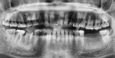 Poza caz pacient implantologie