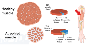 muscle atrophy