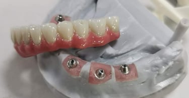 A case of All-on-4 full arch implant denture