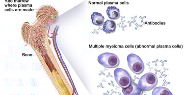 abnormal plasma cells