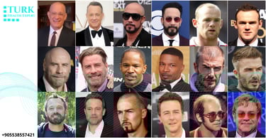 Celebrities hair transplants before and after