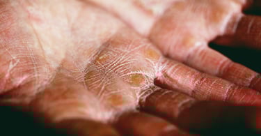 Close-up of dry, cracked skin on human palms showing symptoms of severe hand eczema or dermatitis.