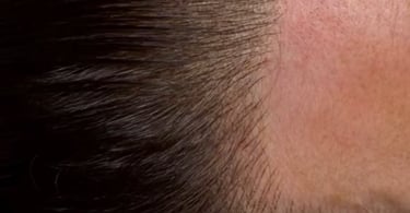 scalp micropigmentation Bruxelles 