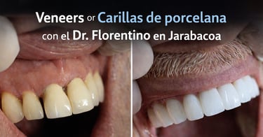 Veneers o Carillas de Porcelana Con el Dr.Florentino en Jarabacoa