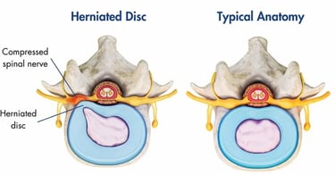 Hernia discal