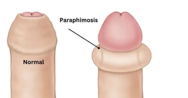 paraphimosis