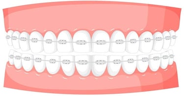 Orthodontics Danger : Risks of demineralization during orthodontic care  hygiene-precision