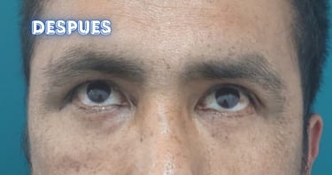 Dra. Lilyan Marissel - Cirugía Plástica y Estética - blefaroplastia-inferior-varon