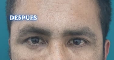 Dra. Lilyan Marissel - Cirugía Plástica y Estética - blefaroplastia-inferior-varon