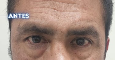 Dra. Lilyan Marissel - Cirugía Plástica y Estética - blefaroplastia-inferior-varon