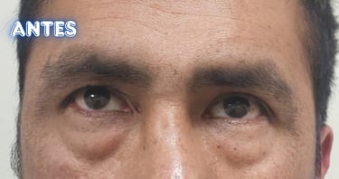 Dra. Lilyan Marissel - Cirugía Plástica y Estética - blefaroplastia-inferior-varon