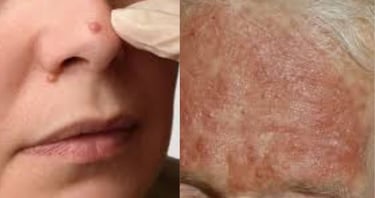 Fatty Liver Disease Can Show Up on Your Face
