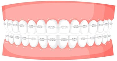 Déminéralisation dentaire pendant un traitement orthodontique hygiene-precision.com
