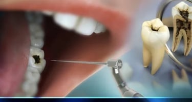 Root Canal Treatment in Greater Noida