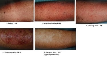 lhr-on-recent-sun-exposed-skin