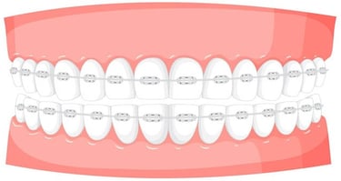 Déminéralisation dentaire pendant un traitement orthodontique hygiene-precision.com