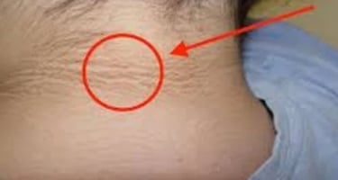 العلامات الخلدية المبكرة لمرض السكر