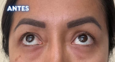 Dra. Lilyan Marissel - Cirugía Plástica y Estética - blefaroplastia-transconjuntival-mujer-bolsas