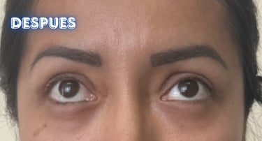 Dra. Lilyan Marissel - Cirugía Plástica y Estética - blefaroplastia-transconjuntival-mujer-bolsas